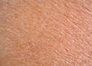 dry skincare