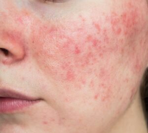 sensitive skin