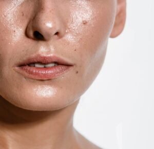 oily skin