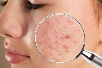 acne disease